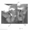 Fig. 20 - Implantable devices for the treatment of incontinence and methods of using same