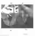 Fig. 22 - Implantable devices for the treatment of incontinence and methods of using same