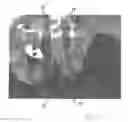 Fig. 23 - Implantable devices for the treatment of incontinence and methods of using same