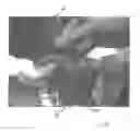 Fig. 25 - Implantable devices for the treatment of incontinence and methods of using same