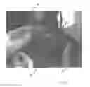 Fig. 27 - Implantable devices for the treatment of incontinence and methods of using same