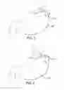 Fig. 04 - LAPAROSCOPIC ADJUSTABLE GASTRIC BAND