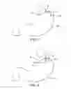 Fig. 05 - LAPAROSCOPIC ADJUSTABLE GASTRIC BAND