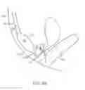 Fig. 13 - Pelvic implant with suspending system