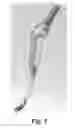 Fig. 05 - VIDEO CRICOTHYROTOMY CAMERA AND CANNULA SYSTEM