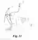 Fig. 08 - VIDEO CRICOTHYROTOMY CAMERA AND CANNULA SYSTEM