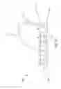 Fig. 52 - ROTATE-TO-ADVANCE CATHETERIZATION SYSTEM