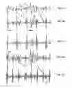 Fig. 11 - Apparatus and method for detecting a fetal heart rate