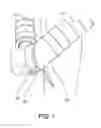 Fig. 02 - GUIDED PERCUTANEOUS BYPASS