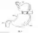 Fig. 02 - Method and device for use in endoscopic organ procedures