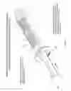 Fig. 18 - METHODS OF TISSUE SAMPLING, COLLECTION, PROCESSING AND RE-INJECTION USING MODULAR, DISPOSABLE TISSUE ASPIRATION, PROCESSING, COLLECTION AND/OR RE-INJECTION COMPONENTS