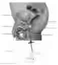 Fig. 23 - Bipolar medical devices for extracting tissue and methods therefor