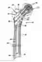 Fig. 01 - APPARATUS FOR TREATING A FRACTURED BONE