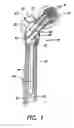 Fig. 02 - APPARATUS FOR TREATING A FRACTURED BONE