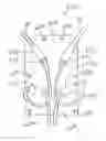 Fig. 01 - DEVICES CONTAINING A SUTURE SLEEVE AND METHODS OF MAKING AND USING