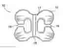 Fig. 01 - Acromioclavicular joint fixation using suture button contstruct with dog bone-shaped button