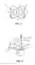 Fig. 02 - Acromioclavicular joint fixation using suture button contstruct with dog bone-shaped button