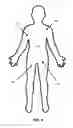 Fig. 07 - Junctional Bleed Device