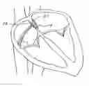Fig. 01 - MEDICAL DEVICE FOR OCCLUDING A HEART DEFECT AND A METHOD OF MANUFACTURING THE SAME