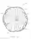 Fig. 04 - MEDICAL DEVICE FOR OCCLUDING A HEART DEFECT AND A METHOD OF MANUFACTURING THE SAME