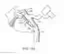 Fig. 14 - Sacral tether anchor and methods of use