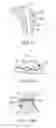 Fig. 24 - Sacral tether anchor and methods of use