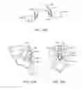 Fig. 25 - Sacral tether anchor and methods of use