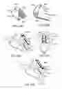 Fig. 26 - Sacral tether anchor and methods of use