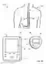 Fig. 02 - Collecting posture and activity information to evaluate therapy