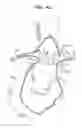 Fig. 07 - Vascular prostheses for treating aneurysms