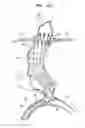 Fig. 35 - Vascular prostheses for treating aneurysms