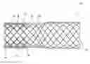 Fig. 01 - Continuous double layered stent for migration resistance