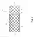 Fig. 02 - Continuous double layered stent for migration resistance