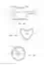 Fig. 28 - Methods and Devices for Delivery of Prosthetic Heart Valves and Other Prosthesis