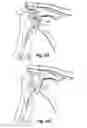 Fig. 30 - Soft tissue repair apparatus and method
