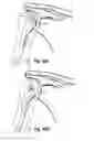 Fig. 32 - Soft tissue repair apparatus and method
