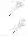 Fig. 06 - Medical device and method for treatment of hip joint