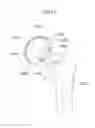 Fig. 16 - Hip joint device and method