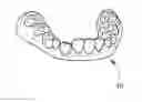 Fig. 01 - Orthodontic aligner fabrication by overlay method