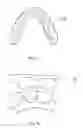 Fig. 06 - Orthodontic aligner fabrication by overlay method