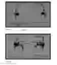Fig. 12 - Particle dispersion device for nasal delivery