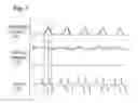 Fig. 04 - METHOD FOR DRIVING A GAS ELECTRIC DISCHARGE DEVICE