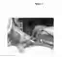 Fig. 02 - Treating burn injuries with reduced hypertrophic scarring