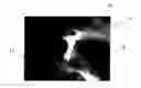 Fig. 01 - Conformable tissue repair implant capable of injection delivery