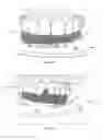Fig. 16 - Tooth positioners, method of making the same, and method of positioning teeth using the same