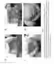 Fig. 04 - PULSED ELECTROMAGNETIC FIELD AND NEGATIVE PRESSURE THERAPY WOUND TREATMENT METHOD AND SYSTEM