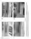 Fig. 07 - PULSED ELECTROMAGNETIC FIELD AND NEGATIVE PRESSURE THERAPY WOUND TREATMENT METHOD AND SYSTEM