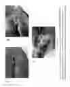 Fig. 11 - PULSED ELECTROMAGNETIC FIELD AND NEGATIVE PRESSURE THERAPY WOUND TREATMENT METHOD AND SYSTEM