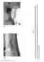 Fig. 12 - PULSED ELECTROMAGNETIC FIELD AND NEGATIVE PRESSURE THERAPY WOUND TREATMENT METHOD AND SYSTEM