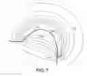 Fig. 08 - Peripheral Brachytherapy of Protruding Conformable Organs